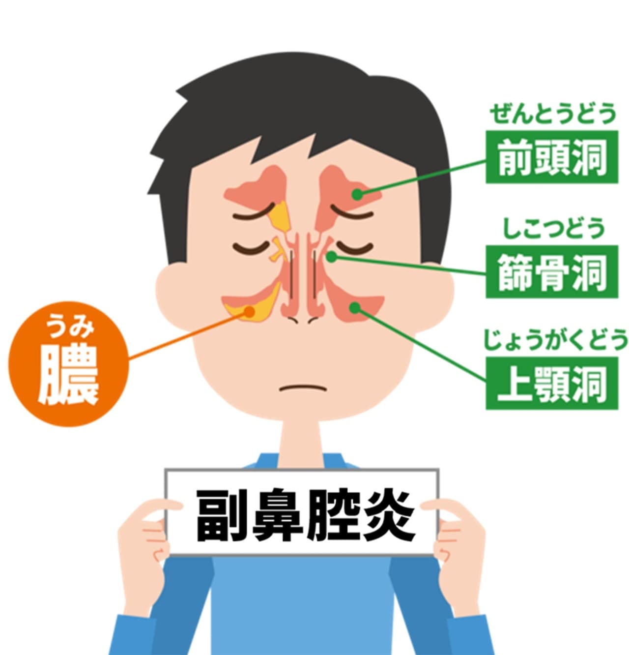 副鼻腔炎（ちくのう症）とは